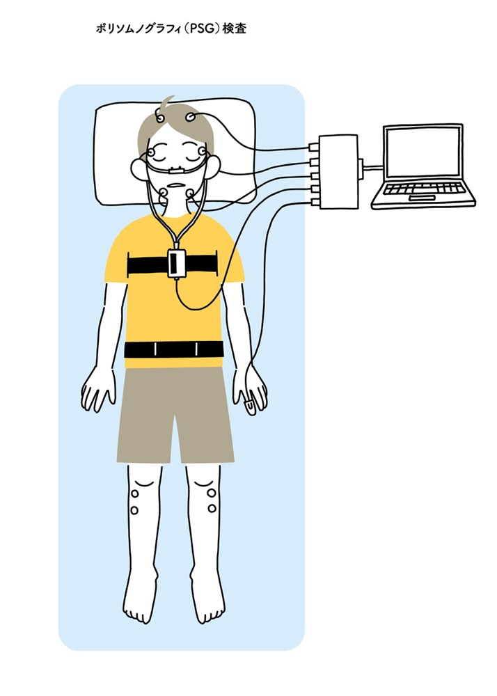終夜睡眠ポリグラフ検査（PSG）