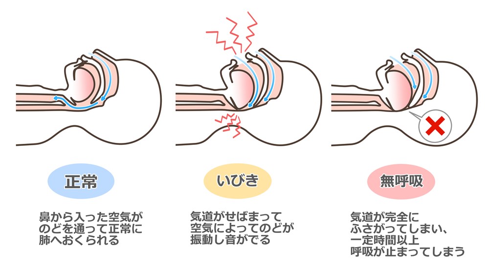閉塞が起こる仕組み