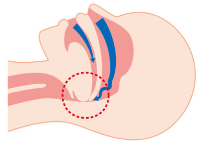 睡眠時無呼吸症候群の原因